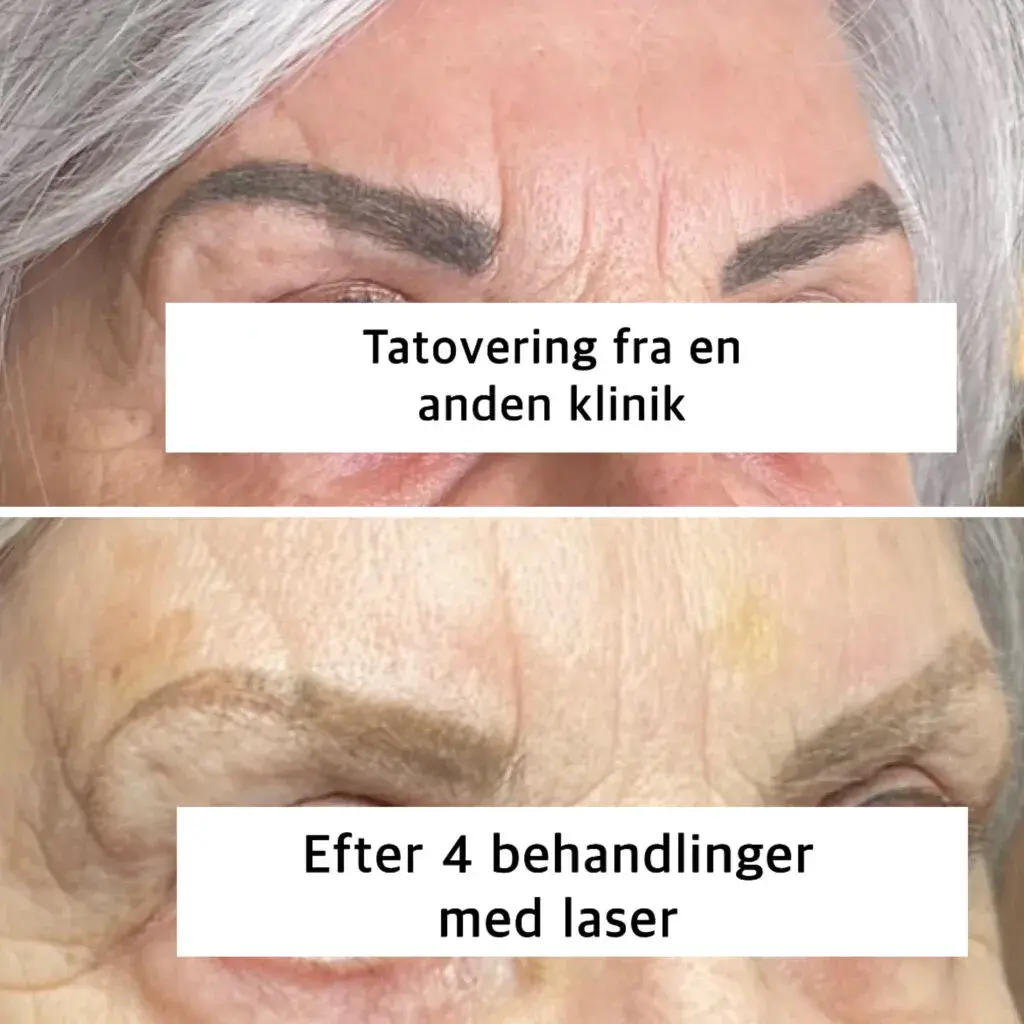 fjernelse af tatoverings