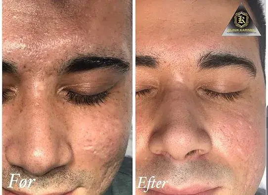 Før og efter billeder af ansigt efter microneedling - synligt reducerede acne-ar, glattere hudtekstur.