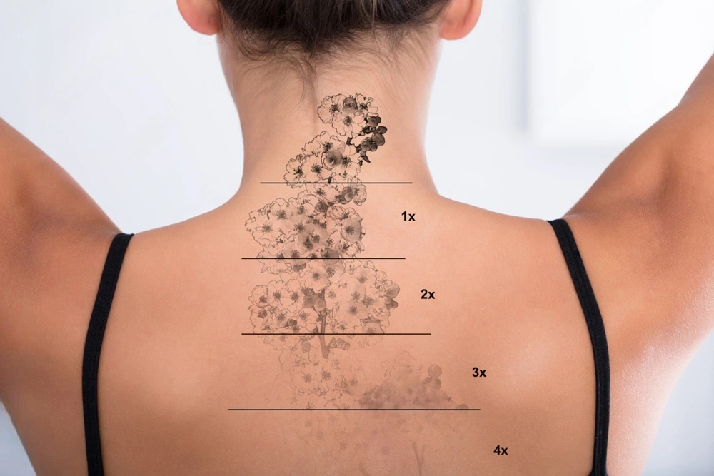 Fjernelse af tatoveringer hos Klinik Karisma
