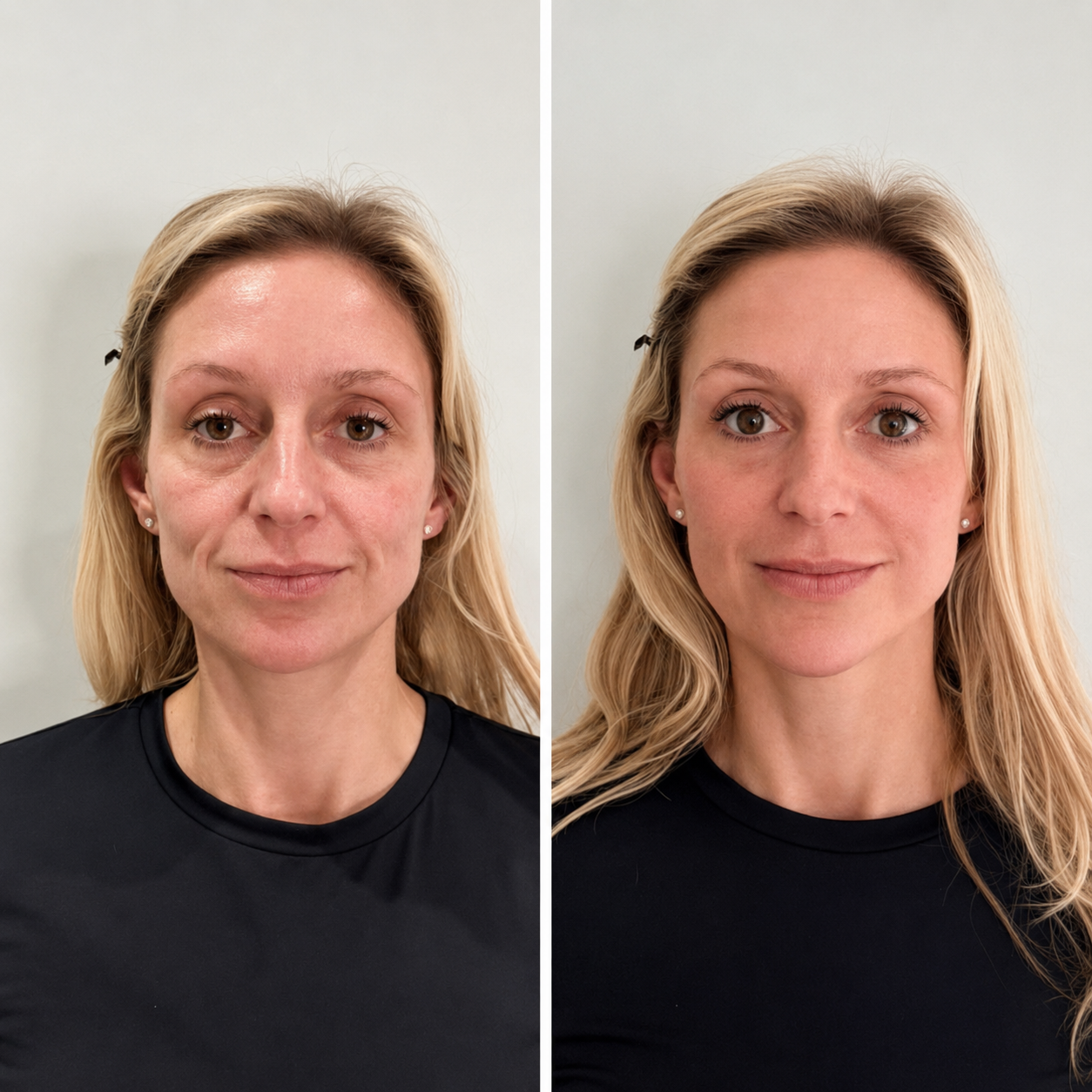 Kvinde får Russian lips filler behandling hos Karenesmat i Silkeborg med naturligt og balanceret resultat